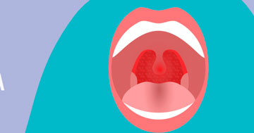Ингаляции при тонзиллите - как проводить в домашних условиях?
