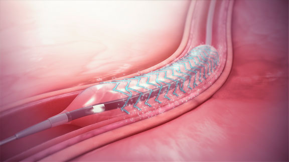 Сколько лет служит стент - срок службы стента